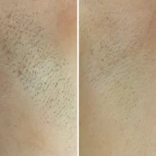 Pacha przed i 8 miesięcy po 3 zabiegach depilacji laserowej LightSheer® – zdjęcie producenta Lumenis