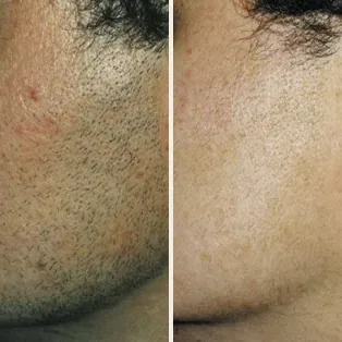 Broda i policzek mężczyzny przed i 5 miesięcy po 3 zabiegach depilacji laserowej LightSheer® – zdjęcie producenta Lumenis
