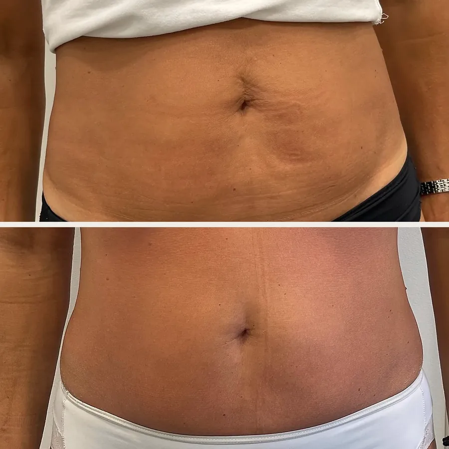 Brzuch przed i po kriolipolizie cooltech® i endermologii LPG® w Płocku