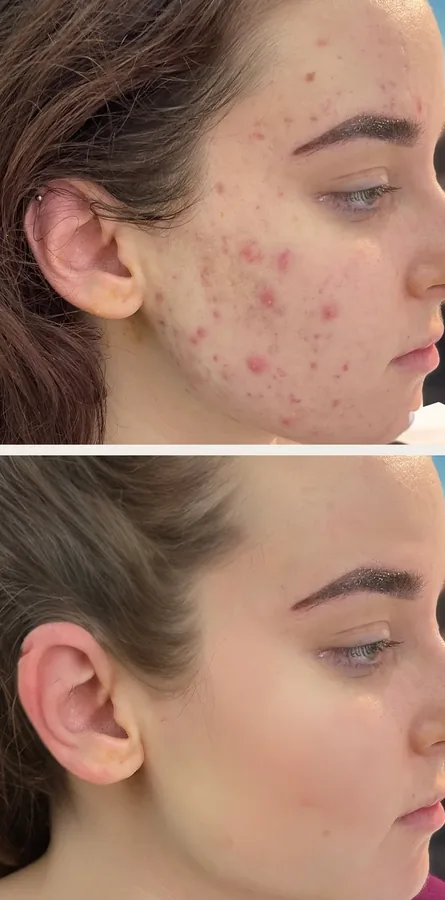 Policzek z trądzikiem przed i po 3 zabiegach peelingu chemicznego w Płocku