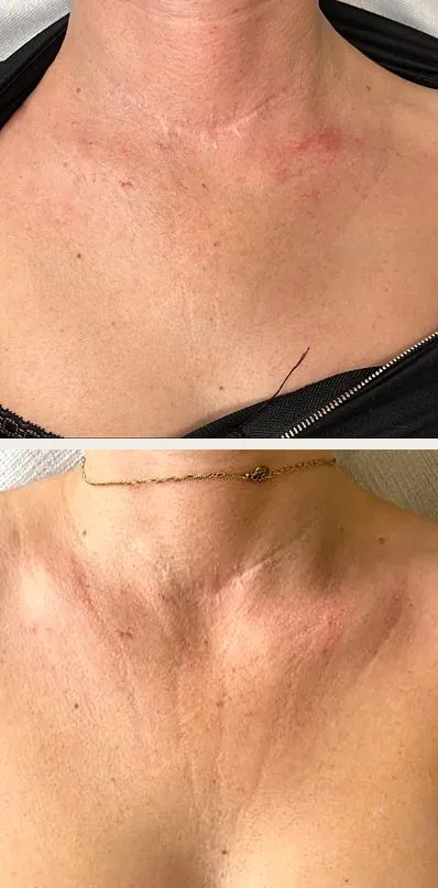 Dekolt przed i po jednym zabiegu peelingu kawowego w Płocku