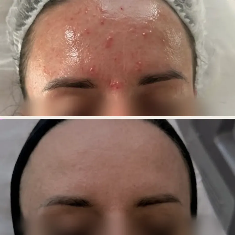 Czoło przed i po jednym zabiegu peelingu chemicznego w Płocku