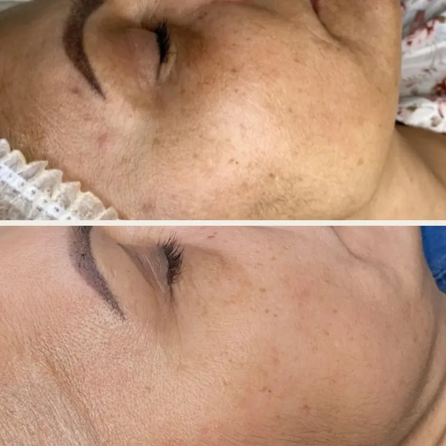 Skóra twarzy przed i po 3 zabiegach peelingu chemicznego i mezoterapii mikroigłowej w Płocku