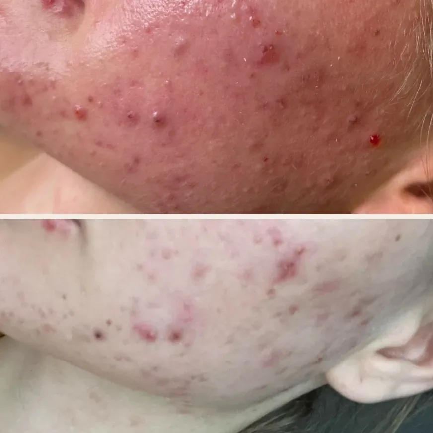 Skóra twarzy z trądzikiem przed i po 6 zabiegach peelingu chemicznego w Płocku