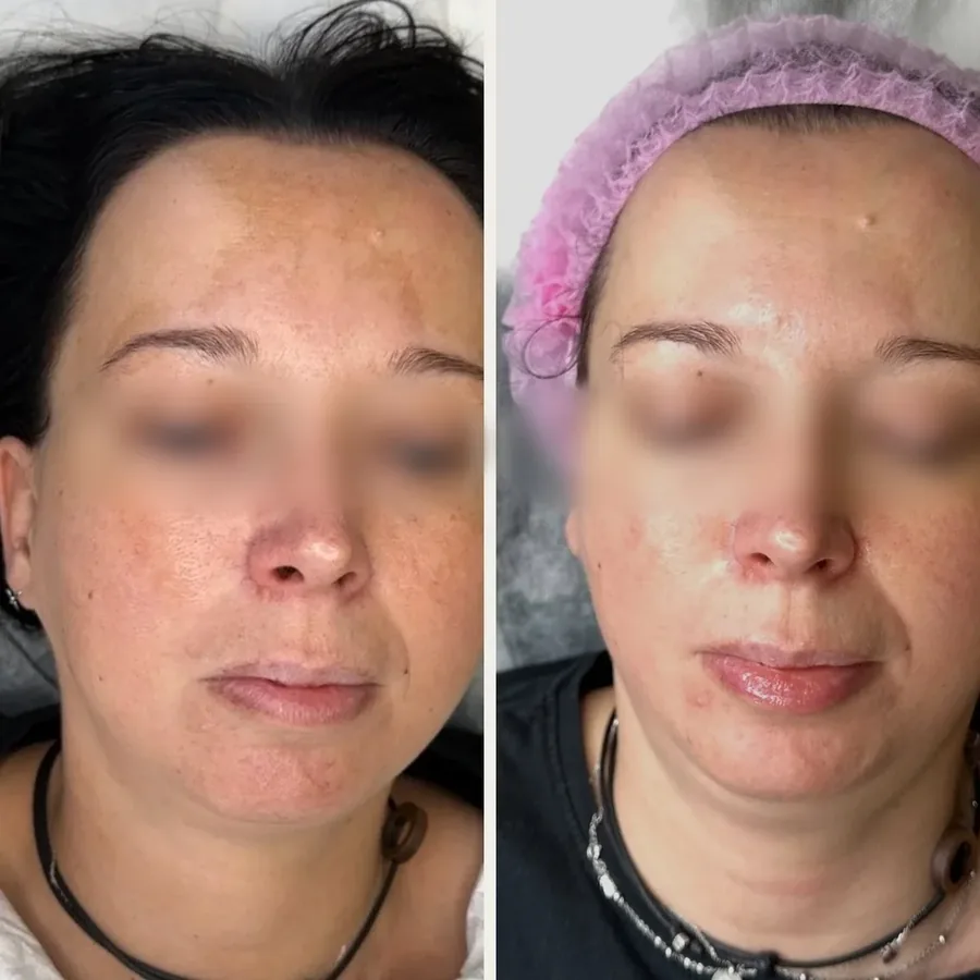 Twarz przed i po 3 zabiegach mikronakłuwania SkinPen® w Płocku