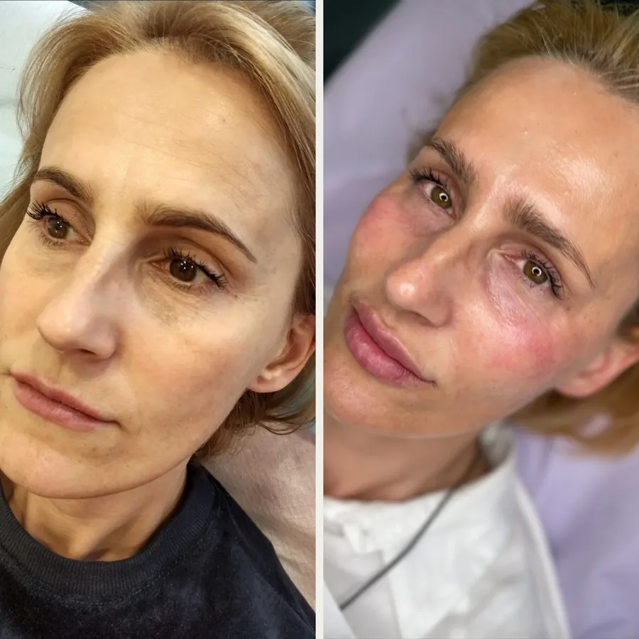 Twarz przed i po 6 zabiegach (stymulatory tkankowe, mezoterapia igłowa i kwas hialuronowy) w Płocku