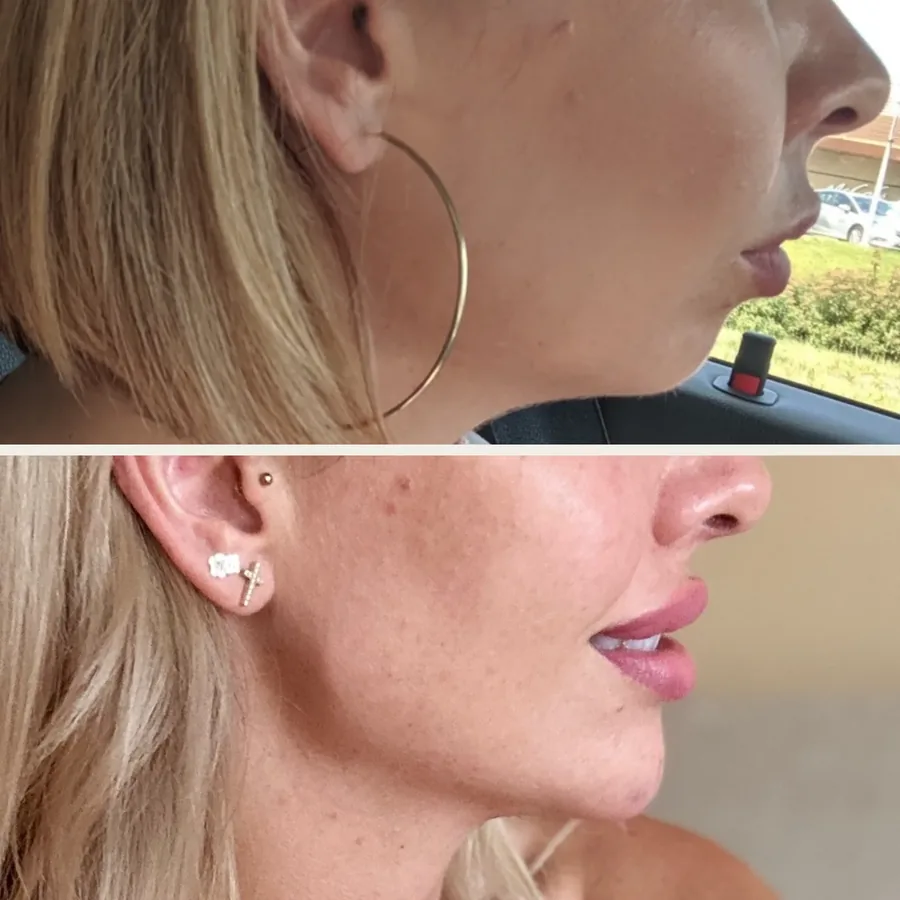 Żuchwa, broda i policzki przed i po jednym zabiegu modelowania kwasem hialuronowym w Płocku