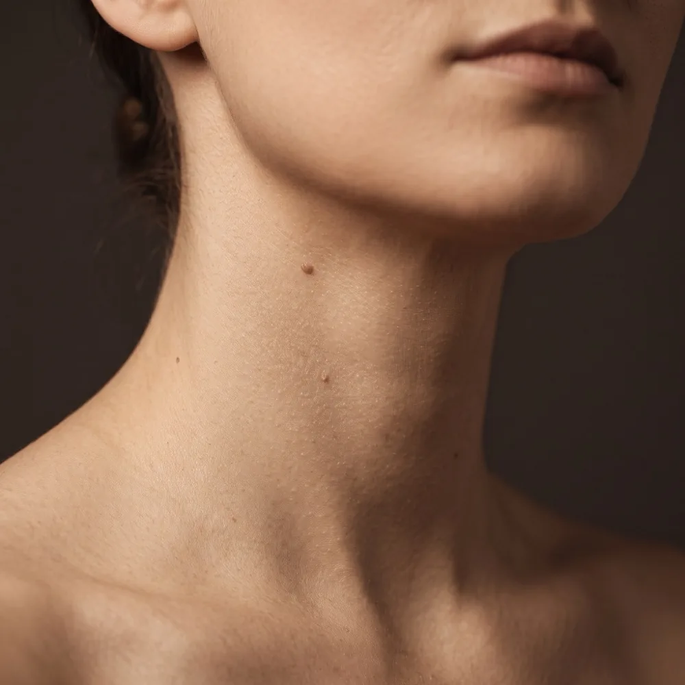 Zabieg Lumiderm® PLASMA™ — usuwanie zmian skórnych